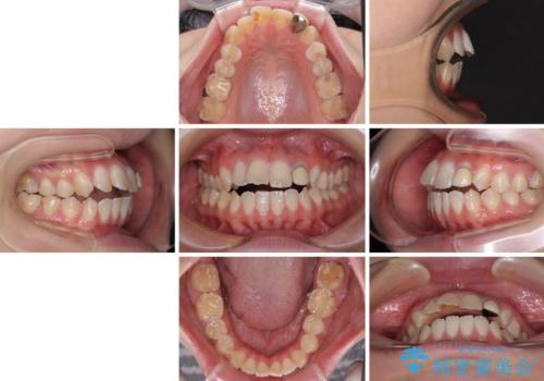 開咬を治す インビザラインによる矯正治療の治療前