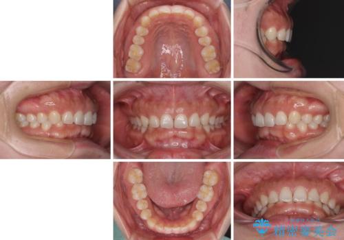 【モニター】ディープバイトを治す ワイヤー装置による矯正治療の治療前
