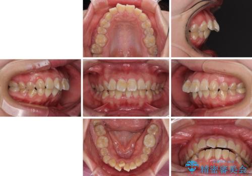 抜歯矯正で唇を閉じやすく ワイヤー矯正の治療前