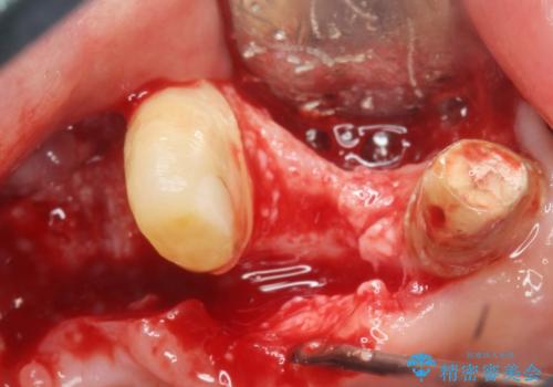 [ 重度の歯周病 ] 骨の造成を伴う奥歯インプラント治療の治療中