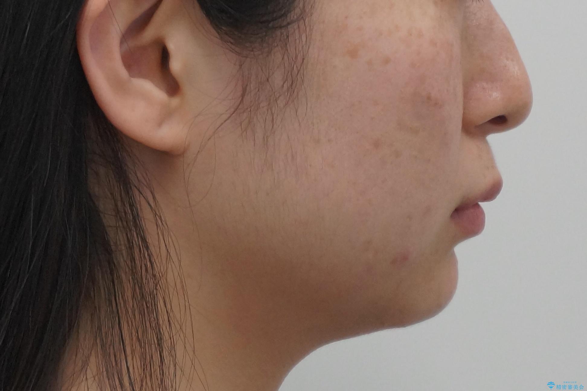 前歯のがたつき、八重歯 インビザラインで抜歯矯正の治療前(顔貌)