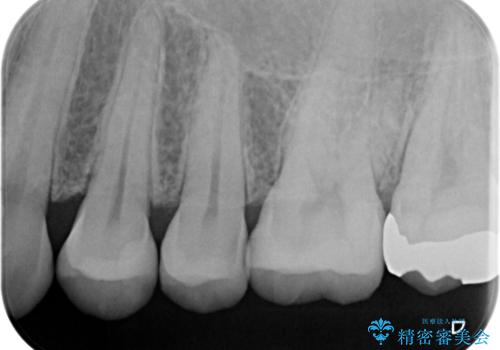 歯と歯の間の虫歯 インレーでの治療(セラミック・ゴールド)の治療後