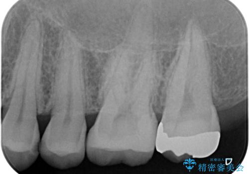 歯と歯の間の虫歯　インレーでの治療(セラミック・ゴールド)の治療中