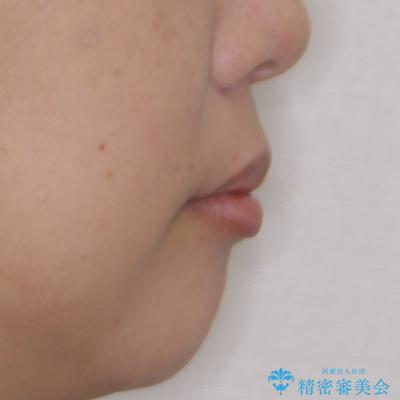 八重歯と出っ歯を治したい ワイヤー装置での抜歯矯正の治療前(顔貌)