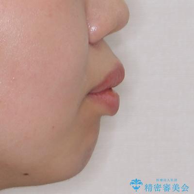 抜歯矯正で唇を閉じやすく ワイヤー矯正の治療前(顔貌)