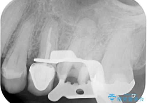 【破折ファイル除去】他院で折れた根管治療の器具をとってほしいの治療中