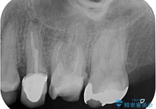 【破折ファイル除去】他院で折れた根管治療の器具をとってほしいの治療前