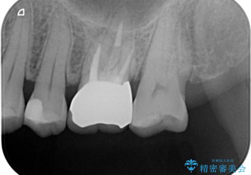 検査で見つかった虫歯 セラミッククラウンでの治療の治療後