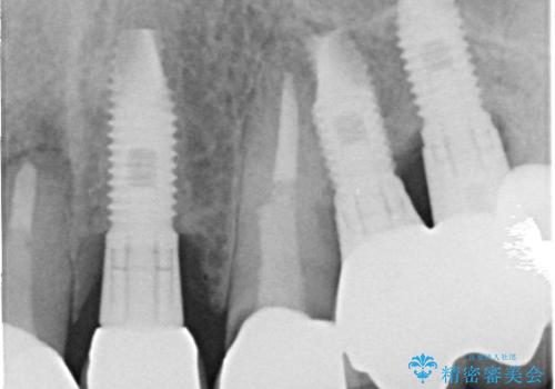 【オールセラミッククラウン・ファイバーコア】被せ物が揺れているの治療前