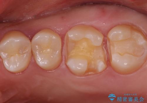 歯と歯の間の虫歯 インレーでの治療(セラミック・ゴールド)の治療中