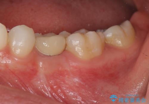 乳歯の残存　インプラントによる置き換えの症例 治療後