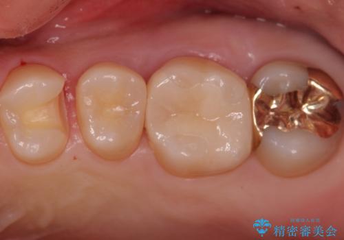 歯と歯の間の虫歯 インレーでの治療(セラミック・ゴールド)の治療中