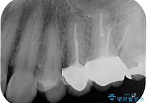 【破折ファイル除去】他院で折れた根管治療の器具をとってほしいの治療後