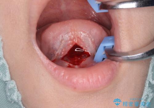 舌が短く話しづらい、滑舌を改善する小手術の治療中