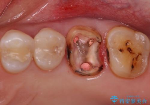 検査で見つかった虫歯 セラミッククラウンでの治療の治療中