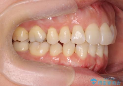 職業柄ワイヤー矯正ができない、マウスピース矯正で行う八重歯抜歯症例の治療後