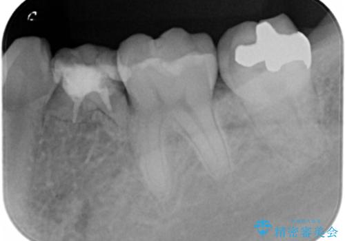 乳歯の残存　インプラントによる置き換えの治療前
