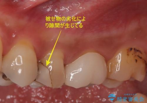 【根管治療・オールセラミッククラウン】何もしなくても歯が痛い 咬むと更に痛いの治療前