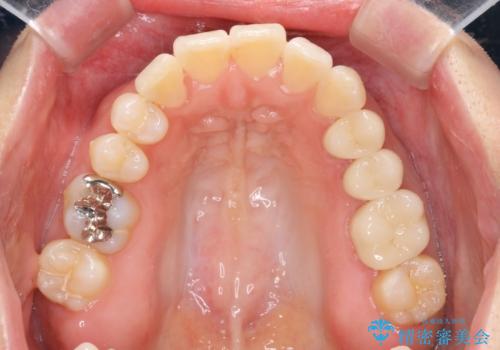 職業柄ワイヤー矯正ができない、マウスピース矯正で行う八重歯抜歯症例の治療後