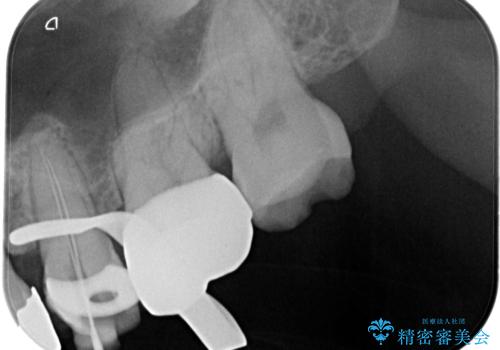 【根管治療・オールセラミッククラウン】何もしなくても歯が痛い 咬むと更に痛いの治療中
