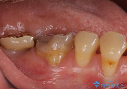 虫歯の治療 できれば歯の向きも変えたいの治療前