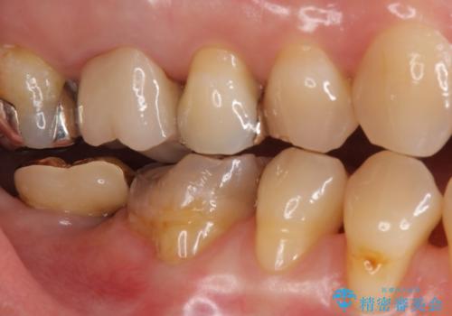 虫歯の治療　できれば歯の向きも変えたいの治療前