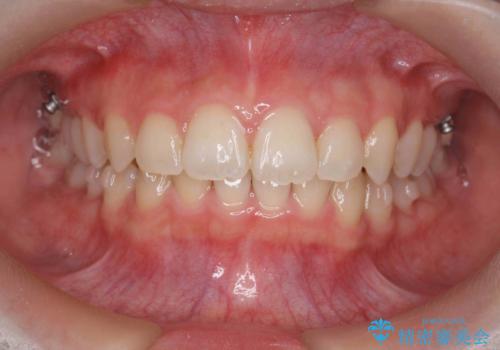[ 鋏状咬合・過蓋咬合・上顎前突 ]  前歯のガタつき、噛みあわせのズレを矯正治療で改善の治療中