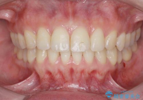 カリエール・マイクロインプラントを併用した歯の突出を改善する大きな遠心移動の症例 治療後