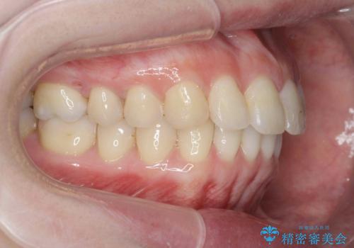 カリエール・マイクロインプラントを併用した歯の突出を改善する大きな遠心移動の治療後