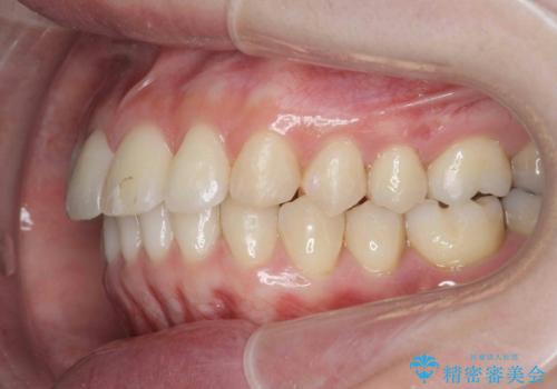 カリエール・マイクロインプラントを併用した歯の突出を改善する大きな遠心移動の治療後