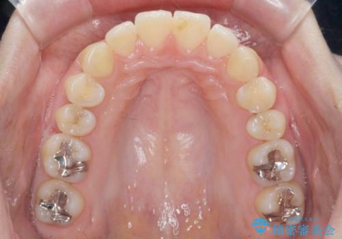 カリエール・マイクロインプラントを併用した歯の突出を改善する大きな遠心移動の治療後