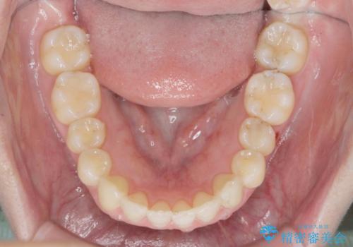 カリエール・マイクロインプラントを併用した歯の突出を改善する大きな遠心移動の治療後