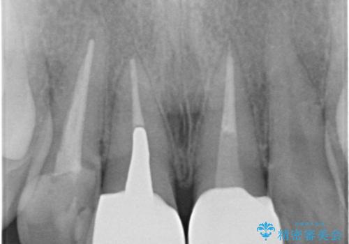 前歯の色が気になる。の治療後