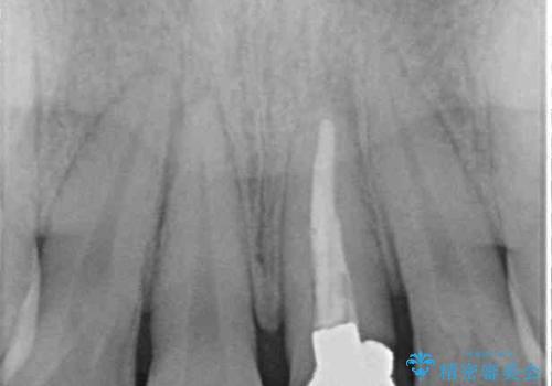 他院で矯正治療中 変色した前歯のオールセラミッククラウン治療の治療前