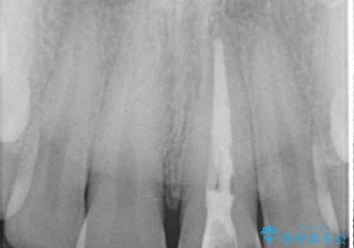 変色した前歯をオールセラミッククラウンにの治療前