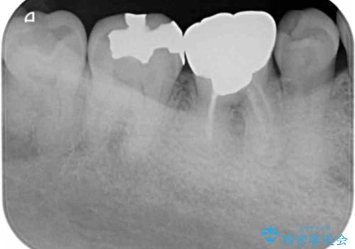 [ 金属アレルギー ] 銀歯を除去するメタルフリー治療の治療前