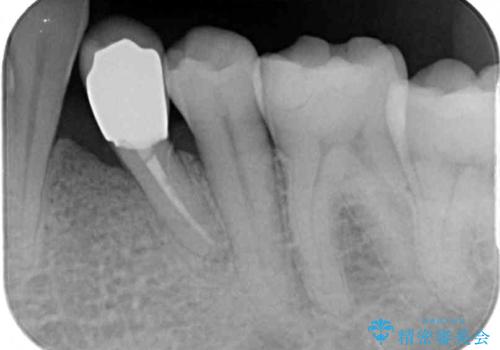 根元で折れてしまった歯を何とか保存する　部分矯正と補綴治療の治療後
