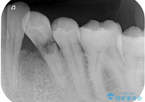 根元で折れてしまった歯を何とか保存する　部分矯正と補綴治療の治療前