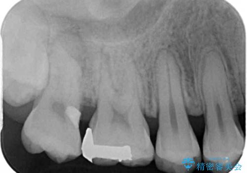 他院で矯正治療中 変色した前歯のオールセラミッククラウン治療の治療前