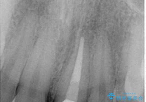 変色した前歯をオールセラミッククラウンにの治療後