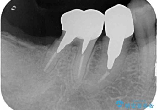 欠損した奥歯のインプラント補綴治療の治療前