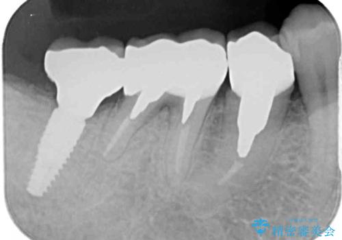 欠損した奥歯のインプラント補綴治療の治療後