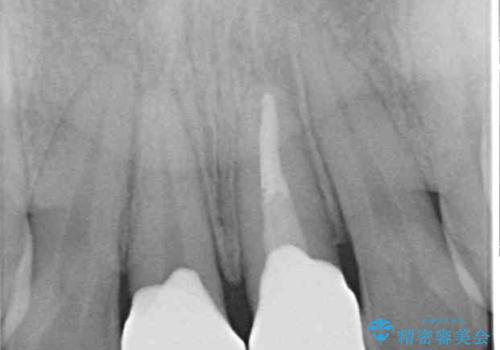 他院で矯正治療中 変色した前歯のオールセラミッククラウン治療の治療後