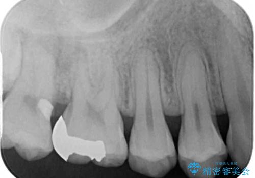他院で矯正治療中 変色した前歯のオールセラミッククラウン治療の治療後