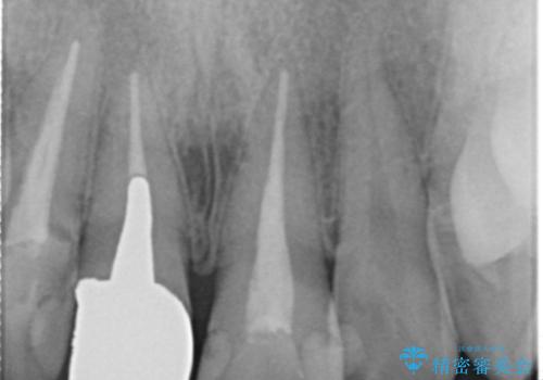 前歯の色が気になる。の治療前
