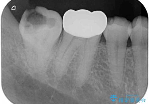 海外赴任前に間に合わせたい 内部でむし歯が進行した奥歯の補綴治療の治療前