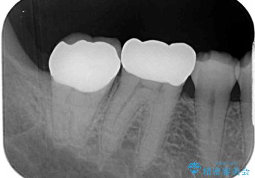 海外赴任前に間に合わせたい 内部でむし歯が進行した奥歯の補綴治療の治療後