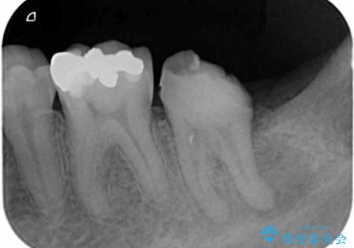 治療途中で放置してしまった歯 根管治療からのセラミック治療の治療前