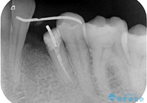 根元で折れてしまった歯を何とか保存する　部分矯正と補綴治療の治療中