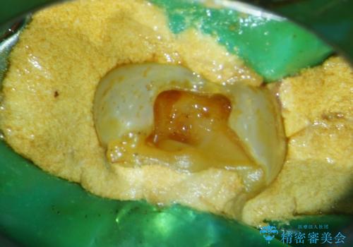 【根管治療・オールセラミッククラウン】何もしなくても歯が痛い 咬むと更に痛いの治療中